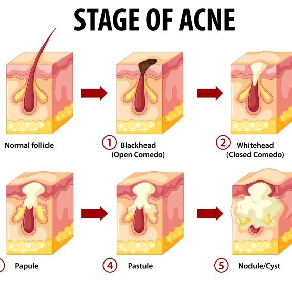 Stages of skin acne anatomy illustration