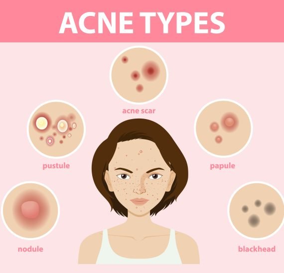 Types of acne on the skin or pimples illustration